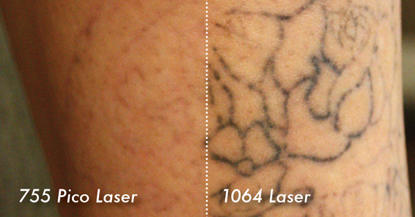 NuMe Metro Daily - PicoSure Tattoo