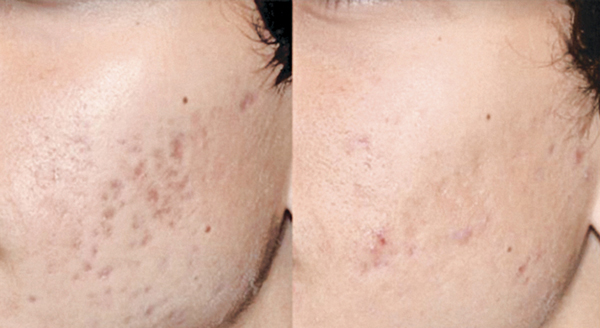 20160816225202picosureacnescars